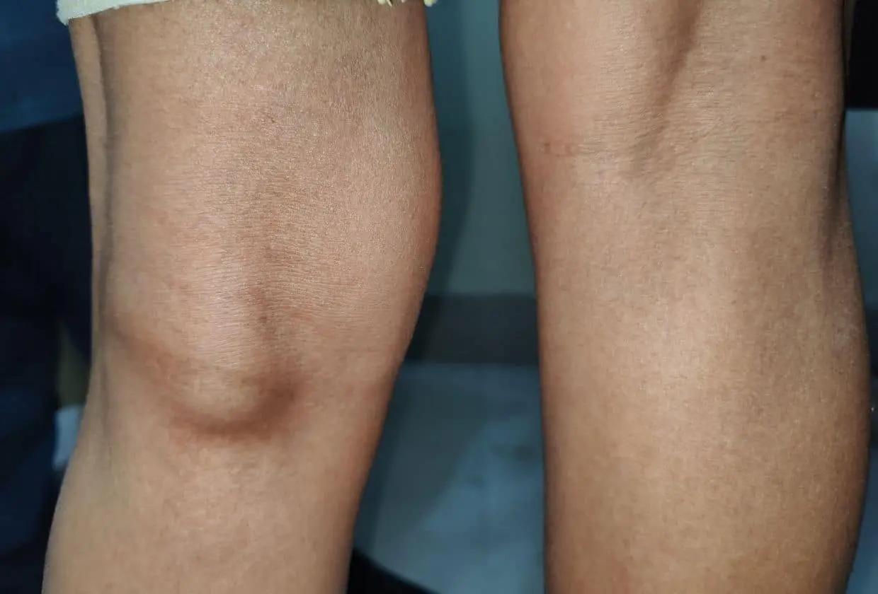 When Your Knee Sends a Pressure Signal: What a Baker’s Cyst Is Really Telling You