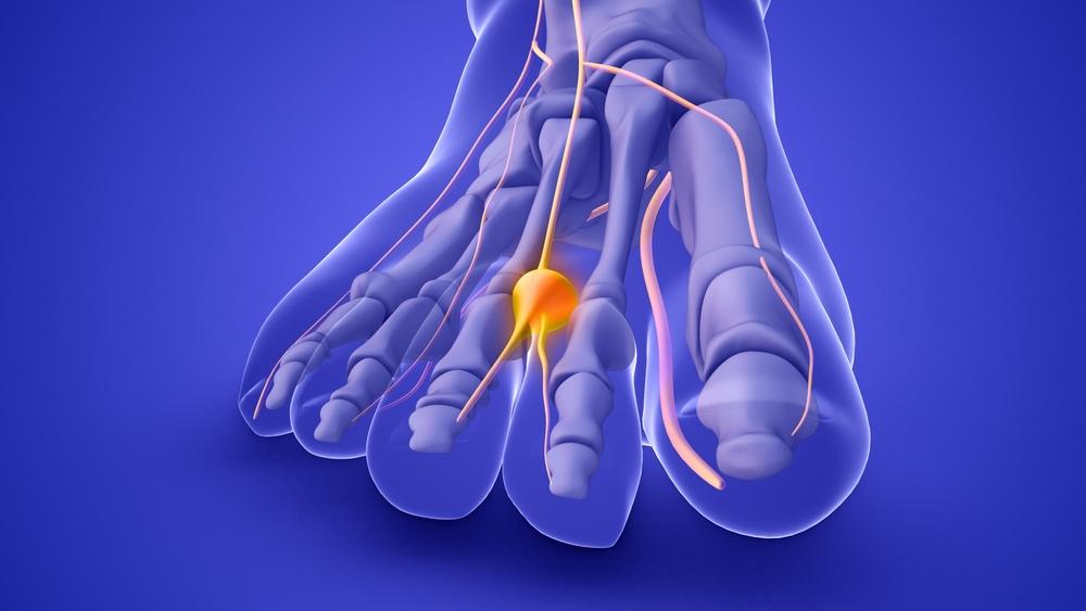 Morton’s Neuroma Treatment: Understanding the Pain Between Your Toes and How to Relieve It