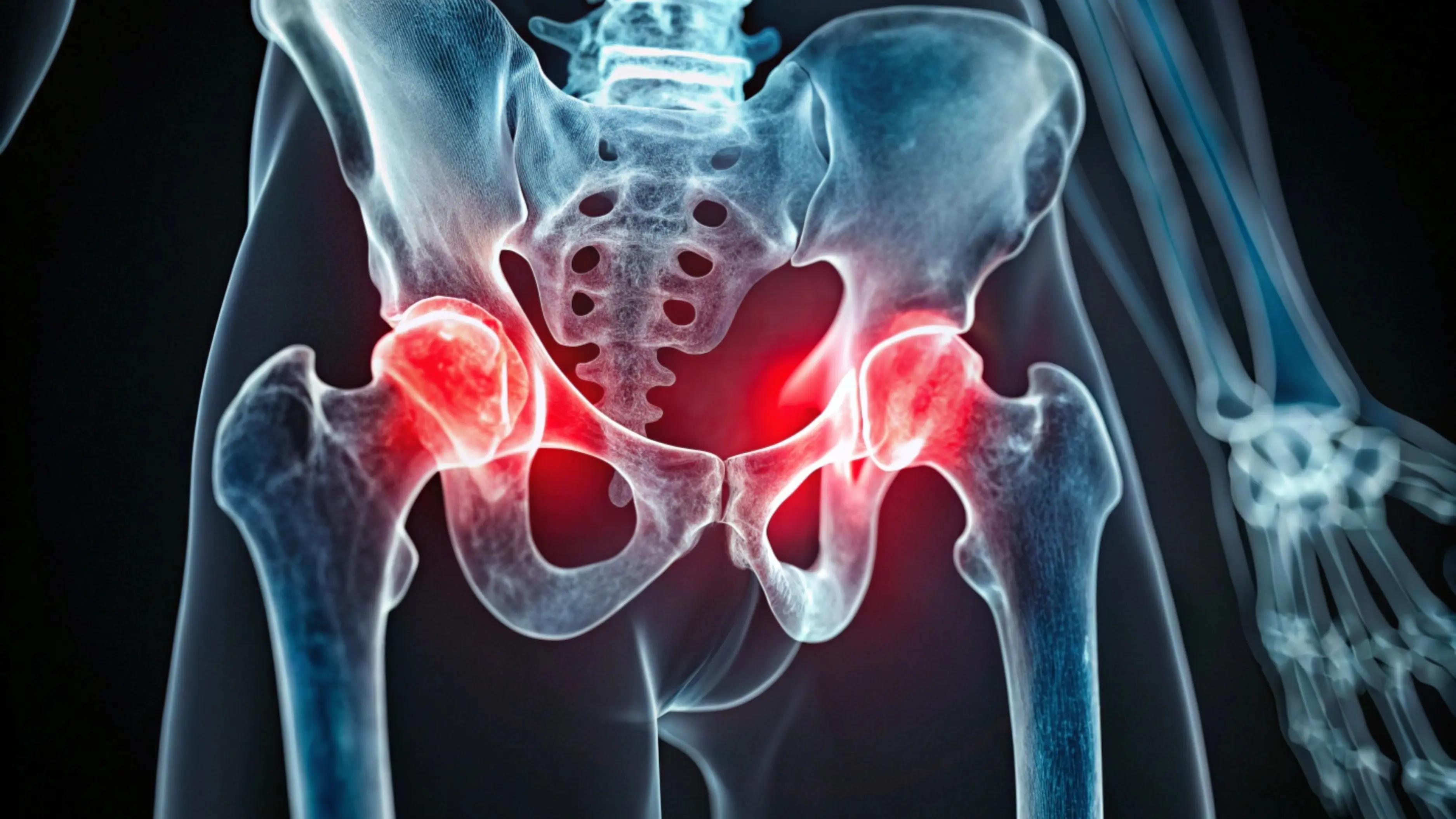 Hip Bursitis: Causes, Research-Backed Treatments & Relief Strategies