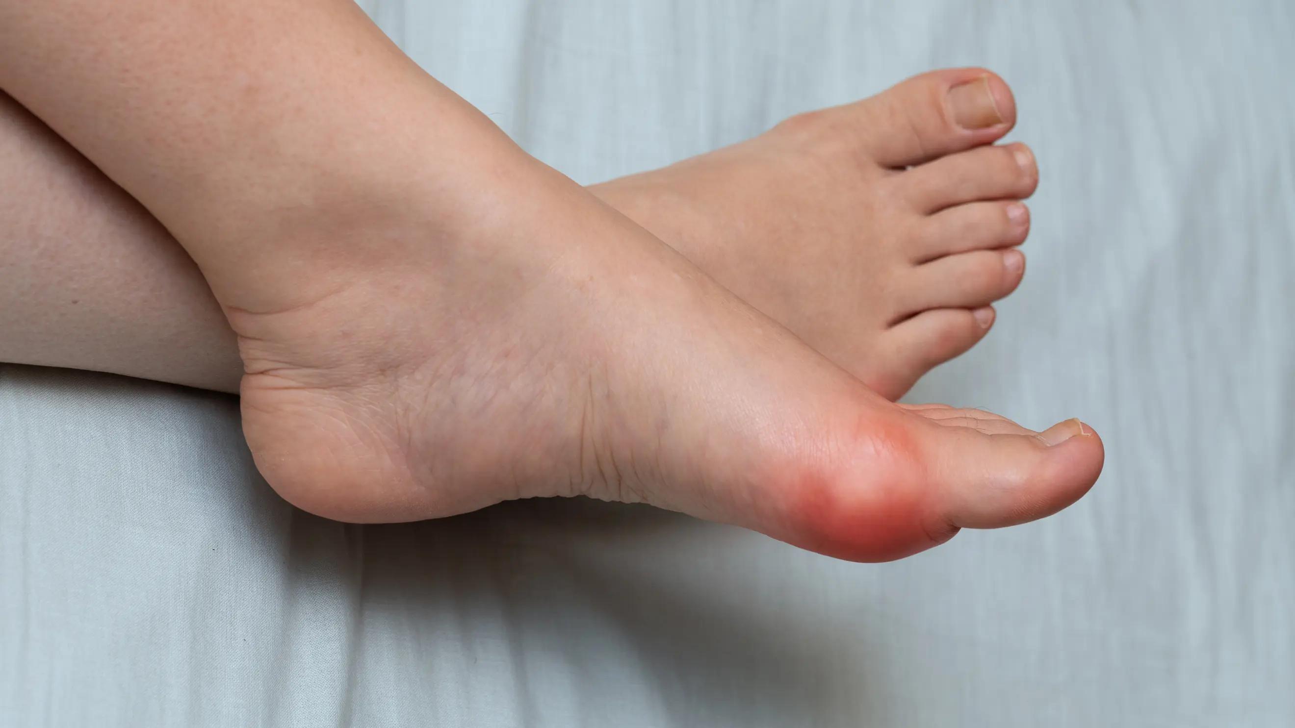 Hallux Rigidus: What It Is & How We Address It at Unpain Clinic