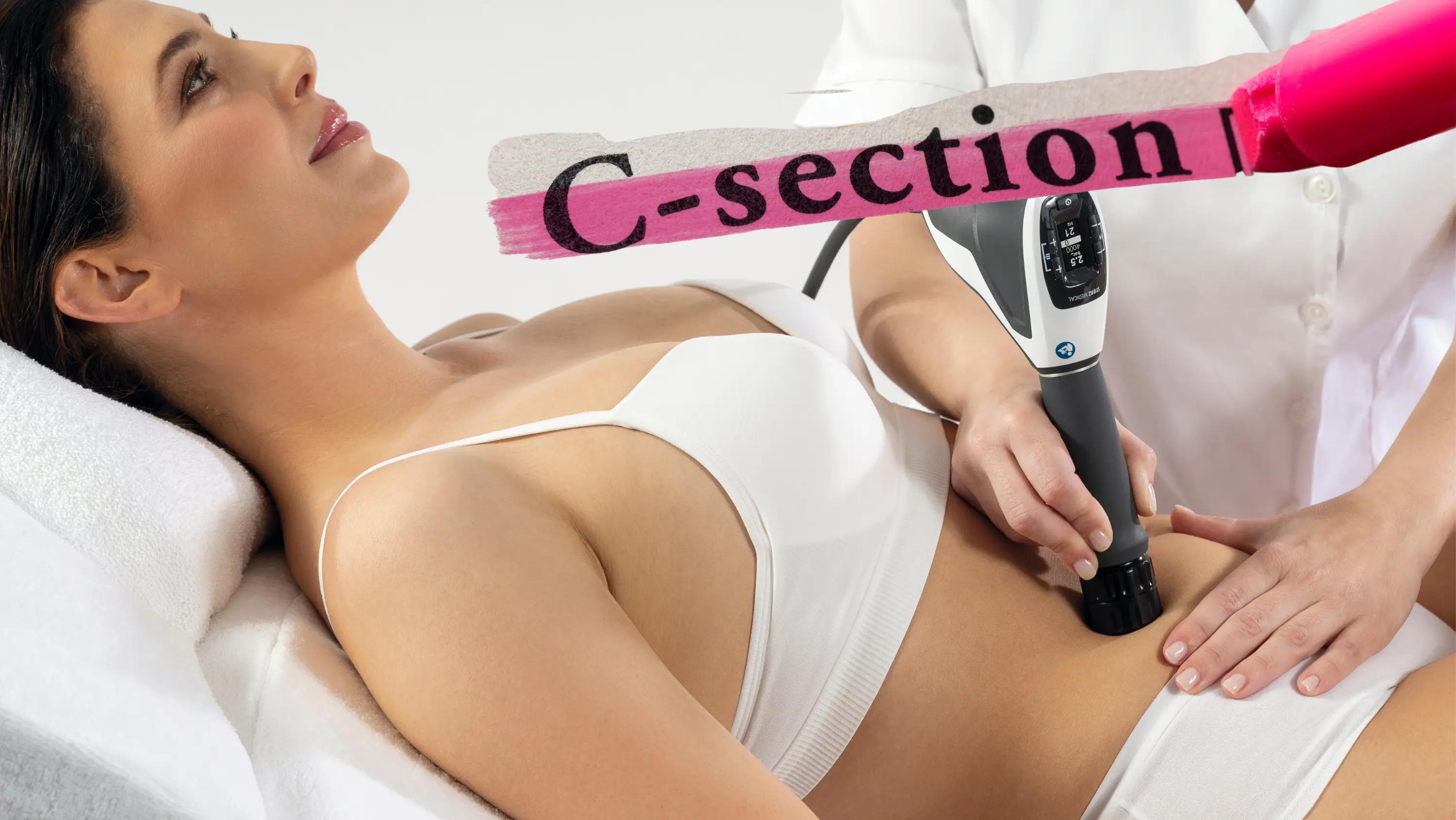 Shockwave Therapy for C-Section Recovery: A Game Changer