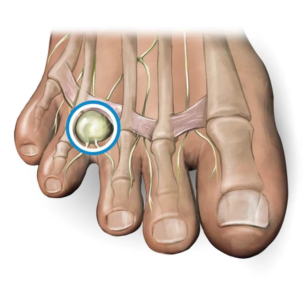 Relieve Morton's Neuroma Pain: The Power of Shockwave Therapy