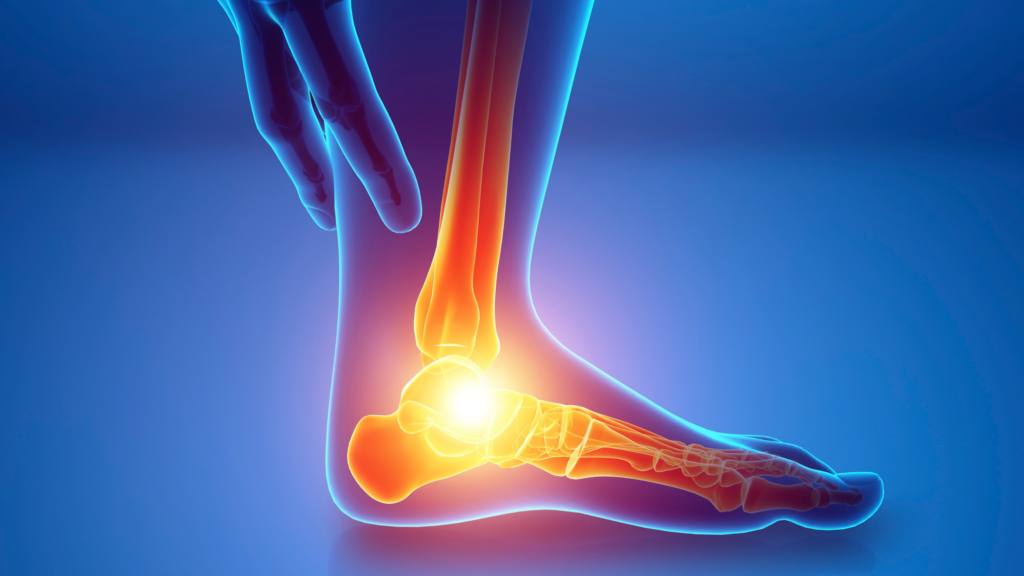 The Link Between Plantar Fasciitis and Heel Spurs